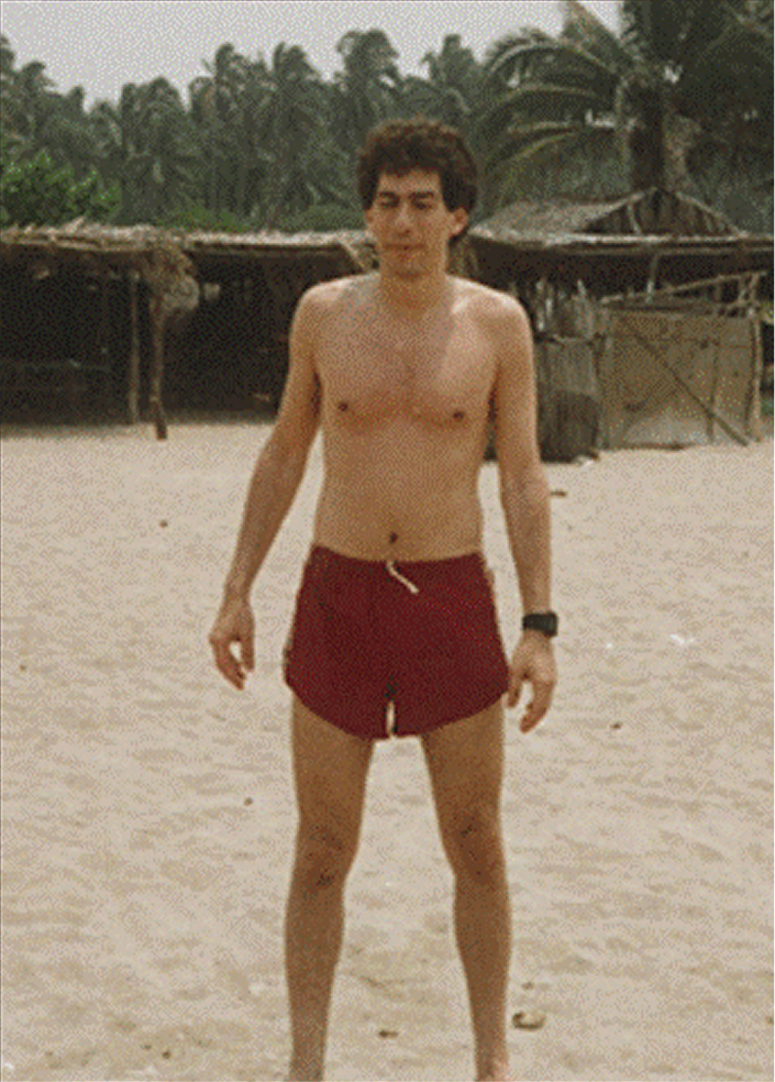 Dr. Rosenbloom on the beach in 1988 at age 35, before focused protocol.